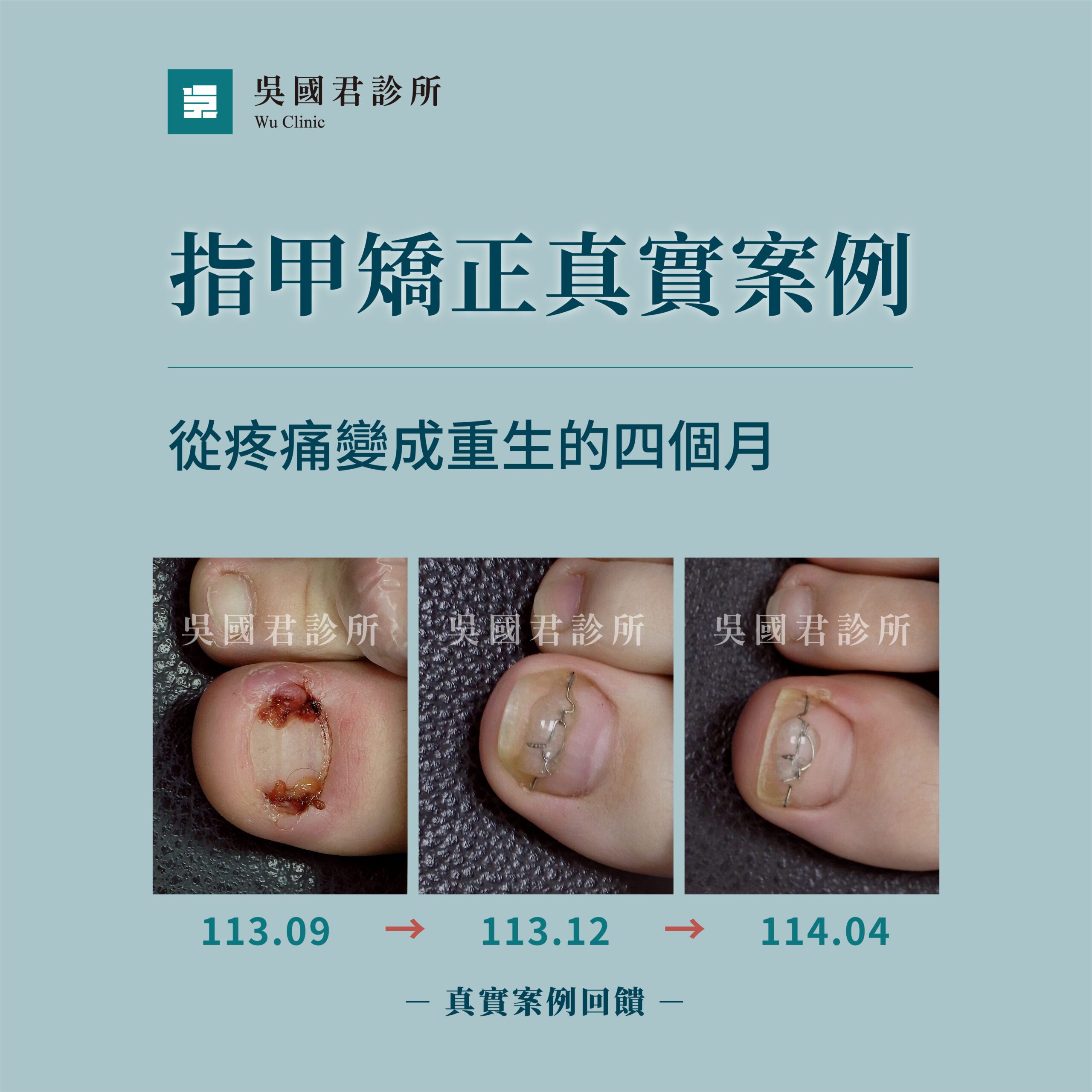 吳國君診所甲溝炎治療案例