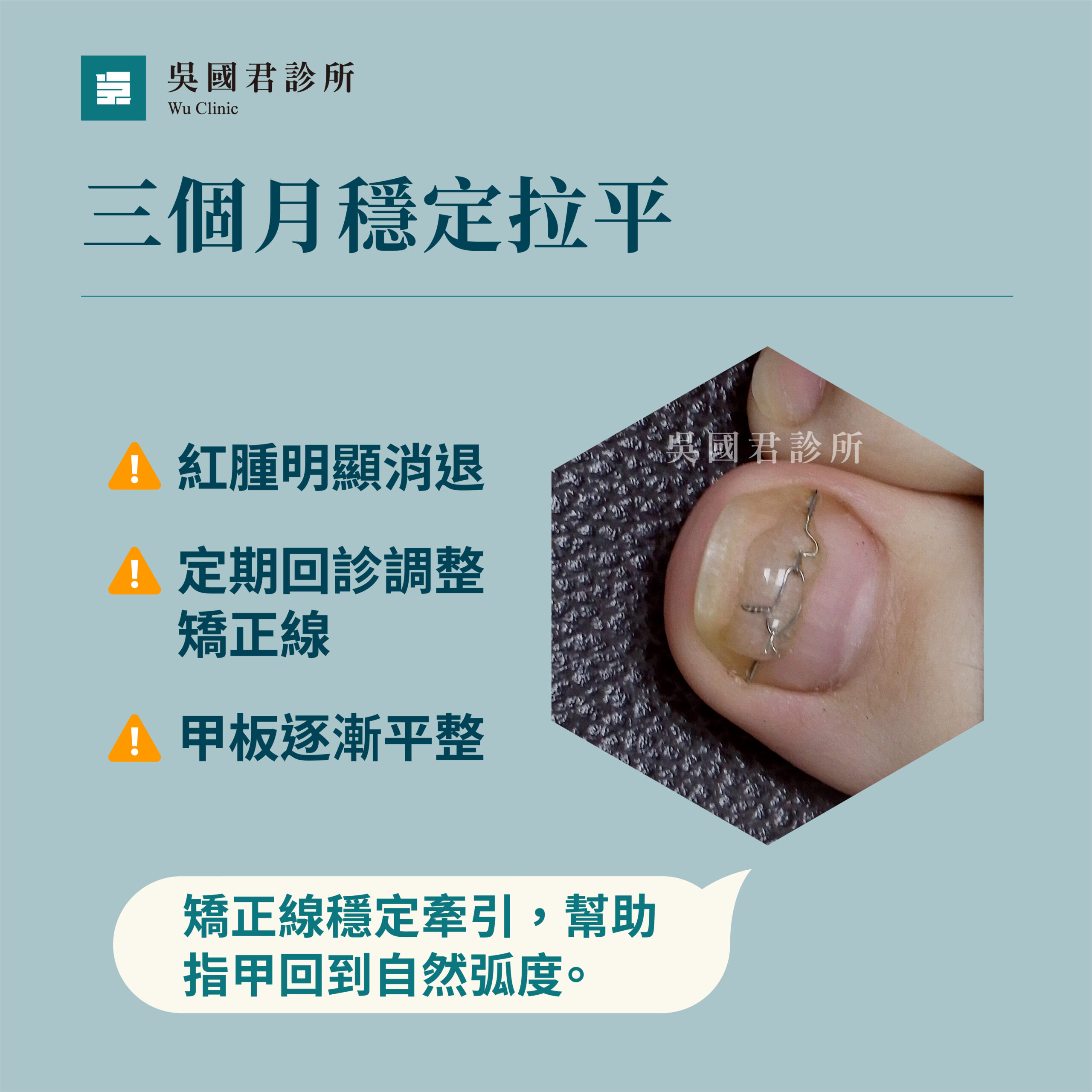 吳國君診所甲溝炎治療3個月