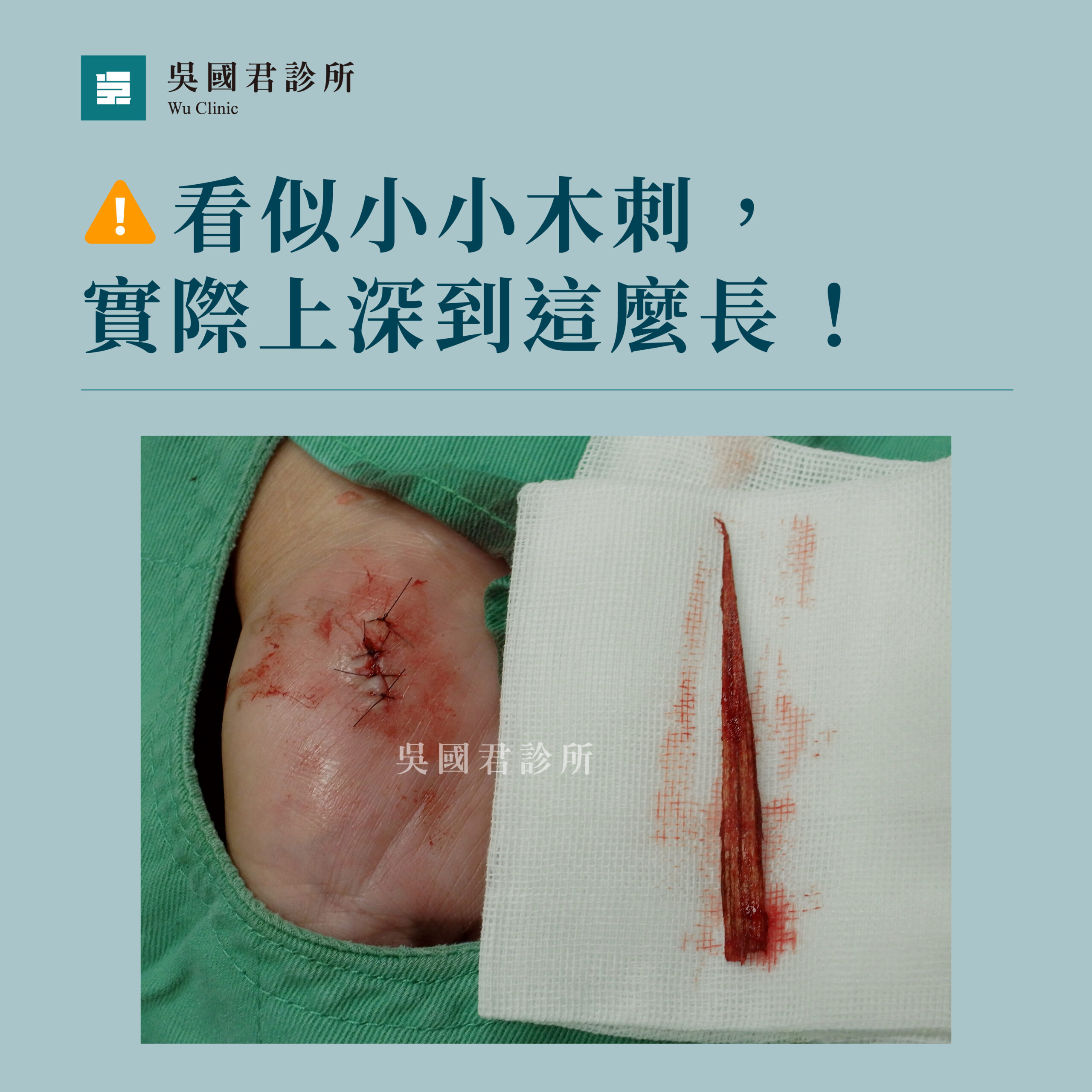 吳國君診所異物穿刺治療