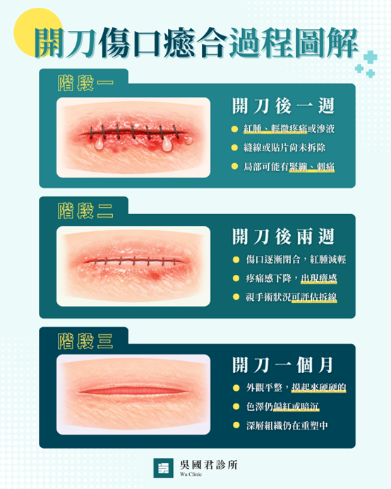 無痛顯微手術開刀傷口癒合過程圖解